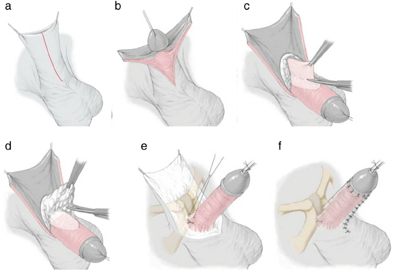 ligamentotoomia peenise suurendamiseks